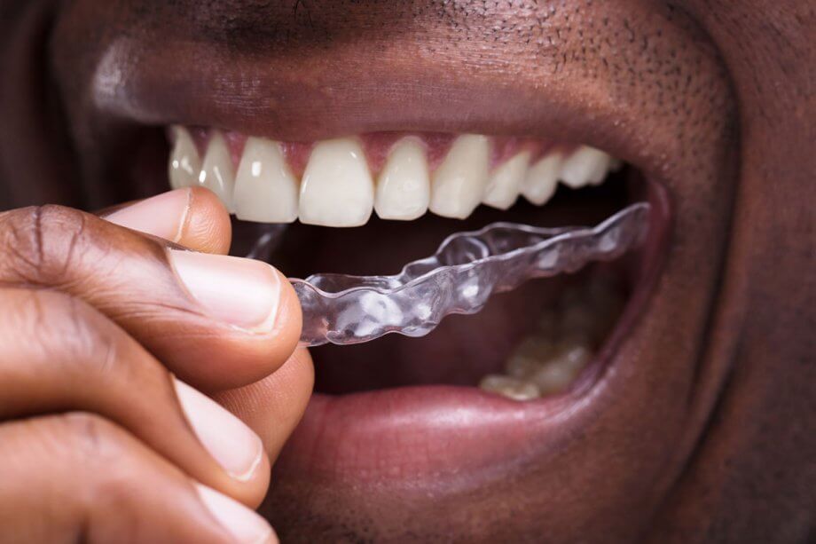 4 Benefits of Invisalign Over Traditional Braces